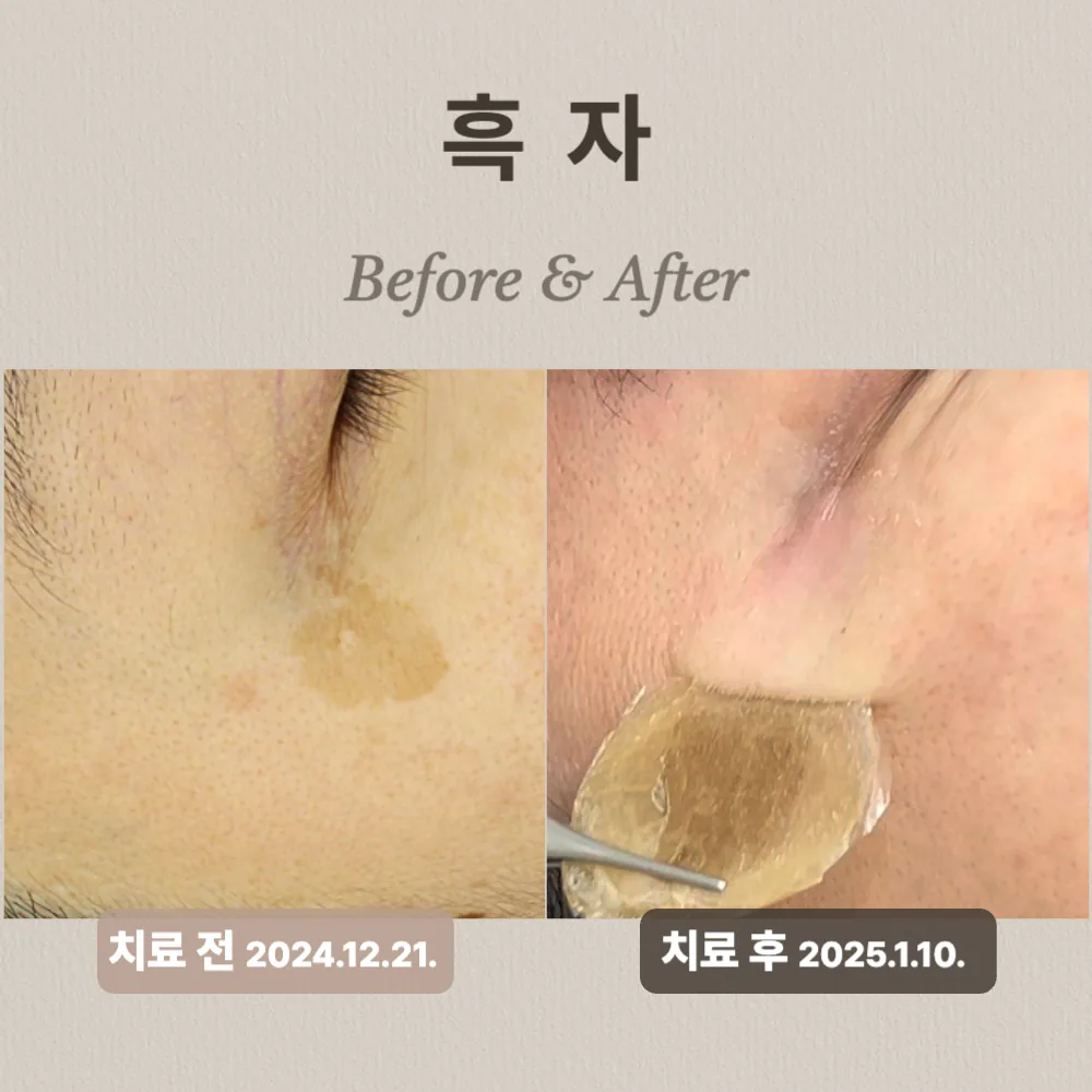 50대 흑자 제거 사례, 리팟레이저