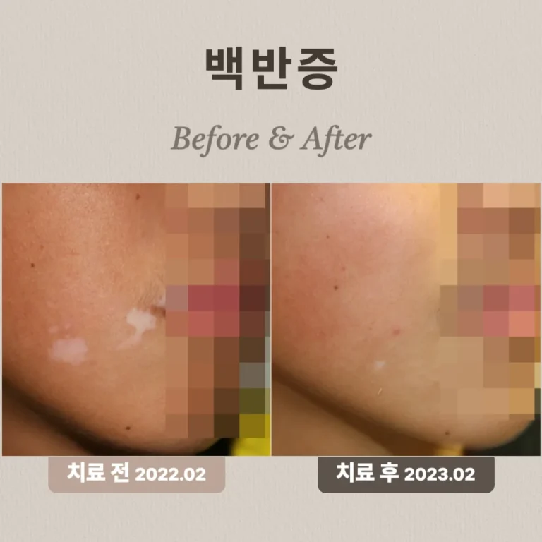 13세 아이, 백반증 치료 사례