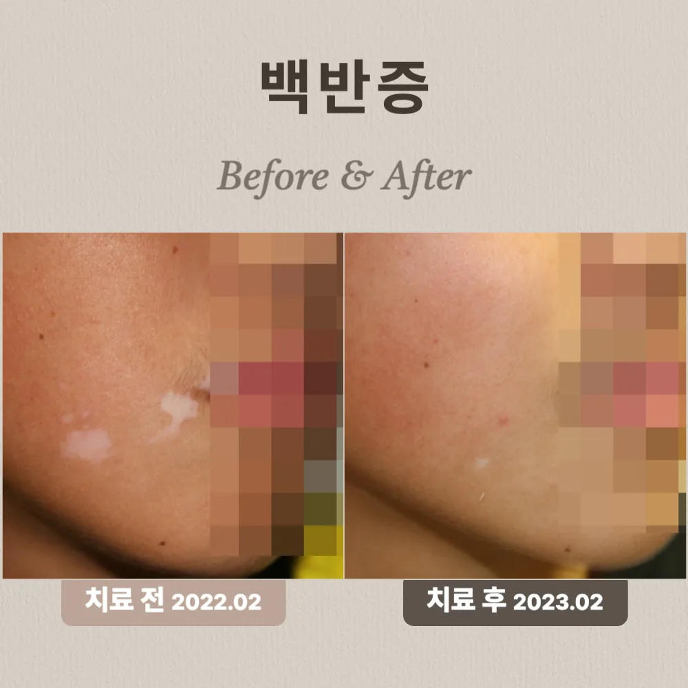 10대 백반증 상담 사례 — 볼의 흰 반점, 치료 전(2022.02)과 치료 후(2023.02) 비교