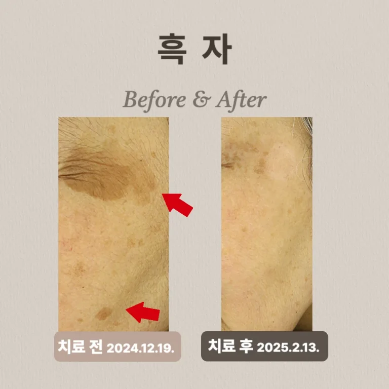 60대 여성,  흑자치료 후기