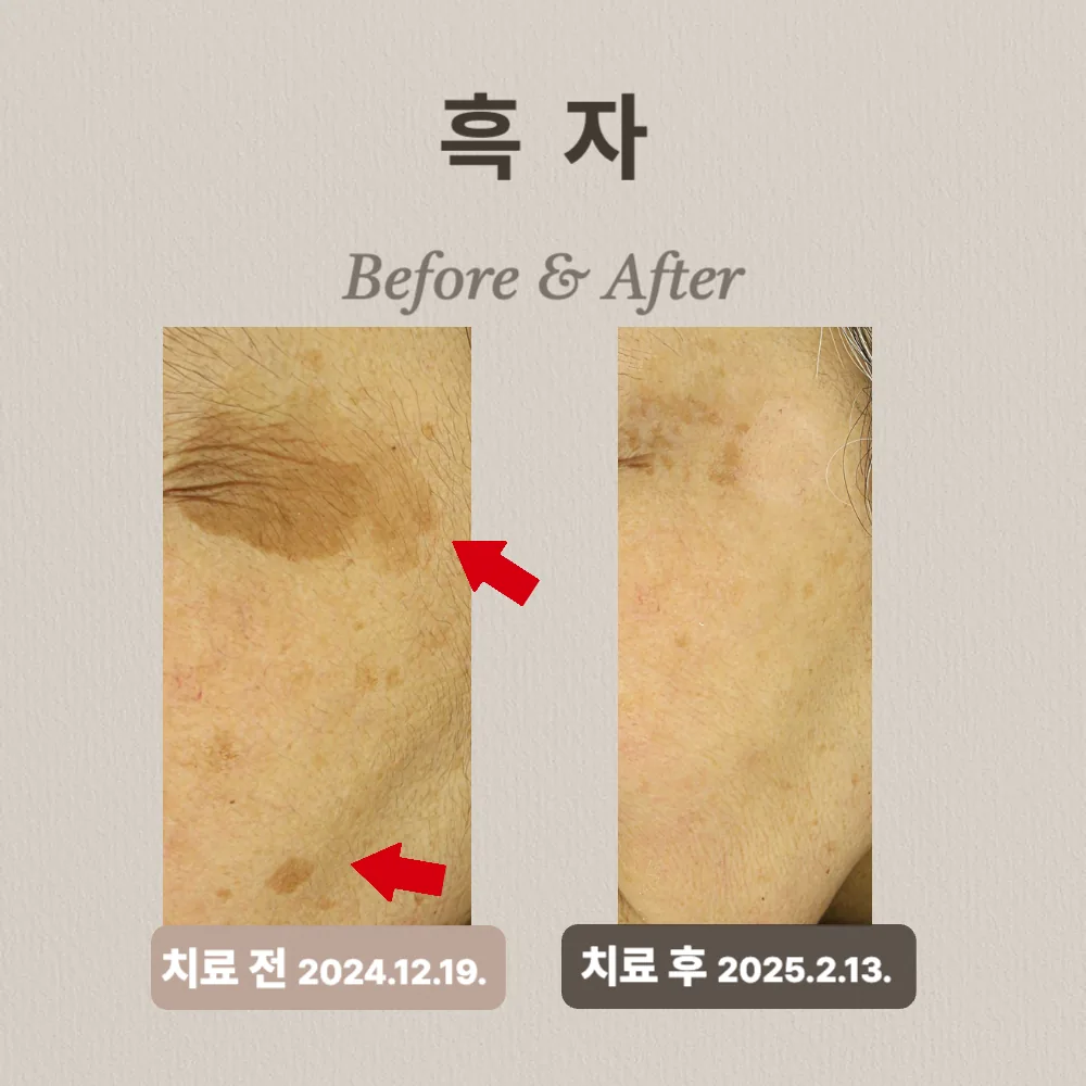 60대 여성,  흑자치료 후기