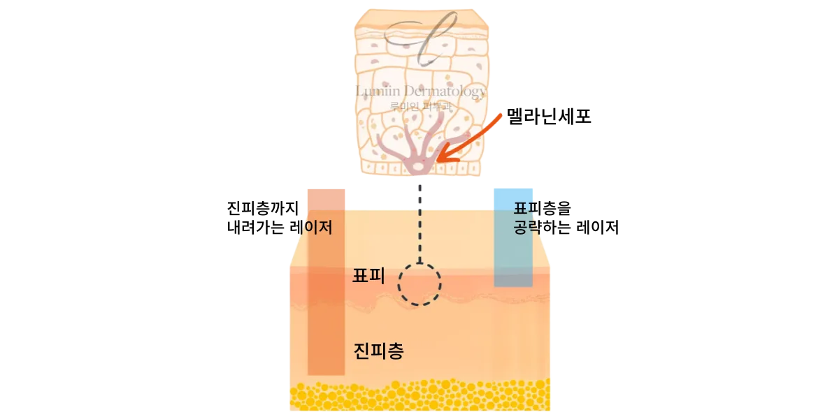 강한 레이저가 멜라닌 세포를 자극하는 레이저토닝 부작용 원리 도해
