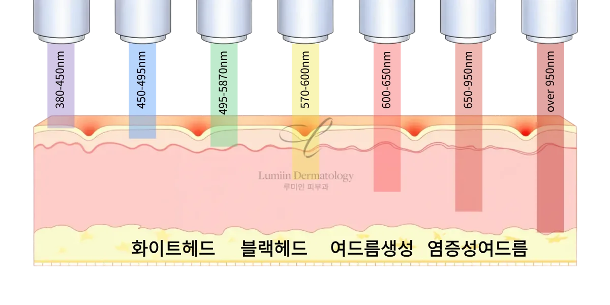 레이저 파장에 따라 피부에 침투하는 깊이가 달라지는 도해