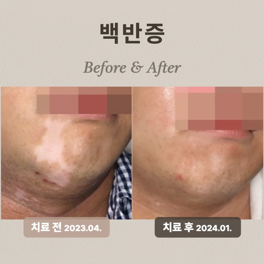 40대 백반증 상담 사례 — 턱 주변의 흰 반점, 치료 전(2023.04)과 치료 후(2024.01) 비교