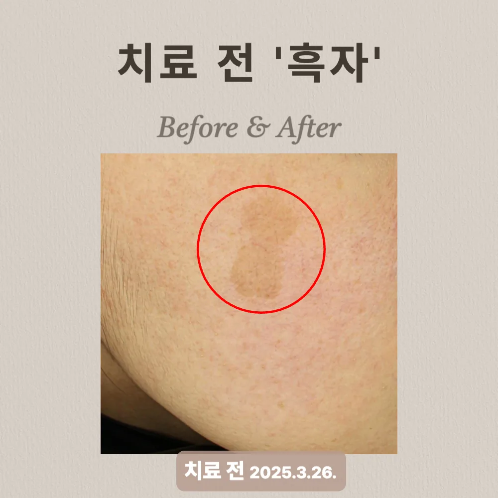 치료 전 흑자 — 눈가와 광대 부위에 나타난 색소