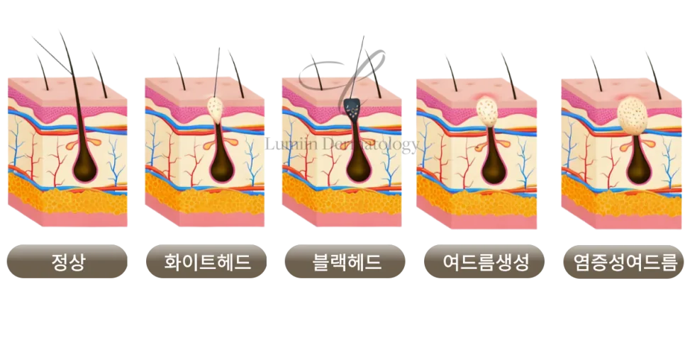 여드름 진행 단계 인포그래픽 — 정상 모공에서 화이트헤드, 블랙헤드, 여드름 생성, 염증성 여드름으로 악화되는 과정