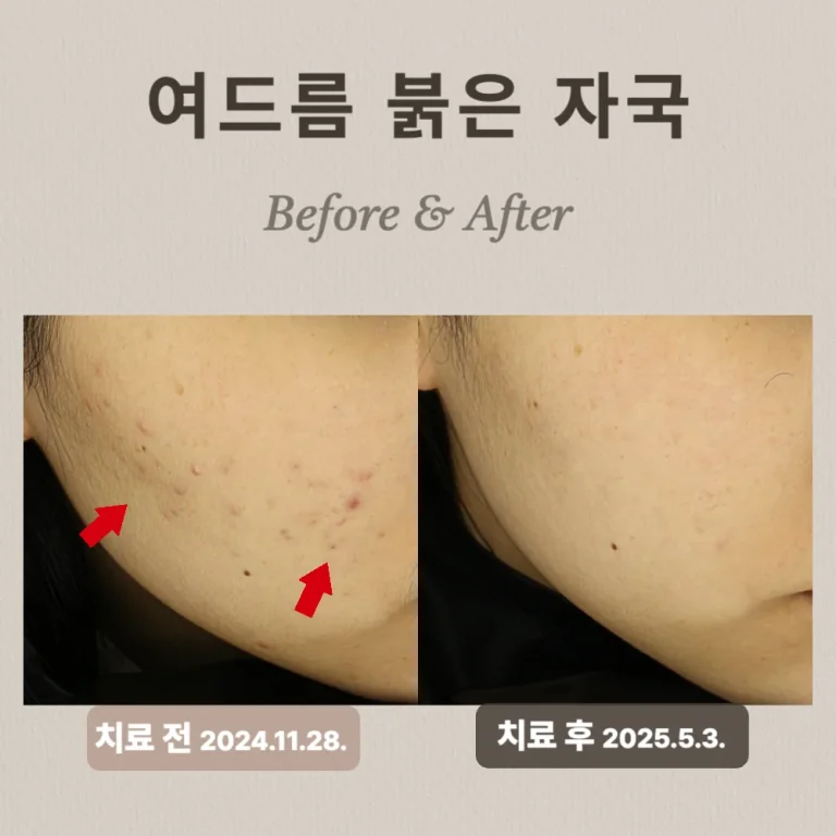 20대 여성, 여드름, 여드름홍반 치료 후기