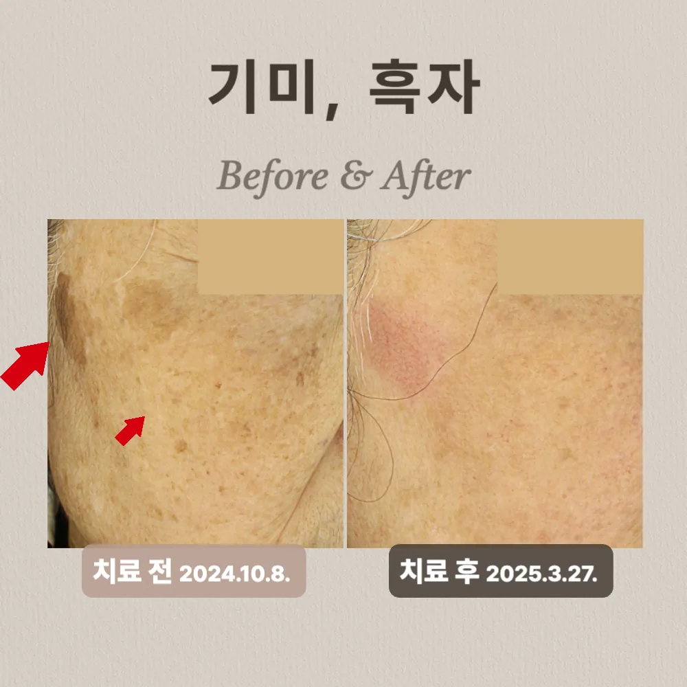 기미, 흑자 상담 사례