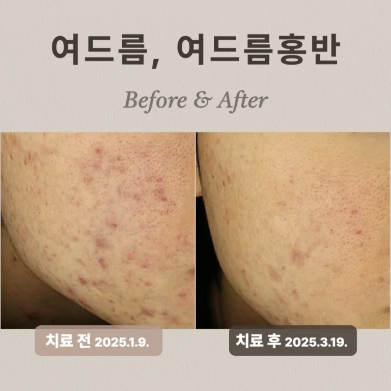 20대 남성, 여드름, 여드름홍반 치료 후기