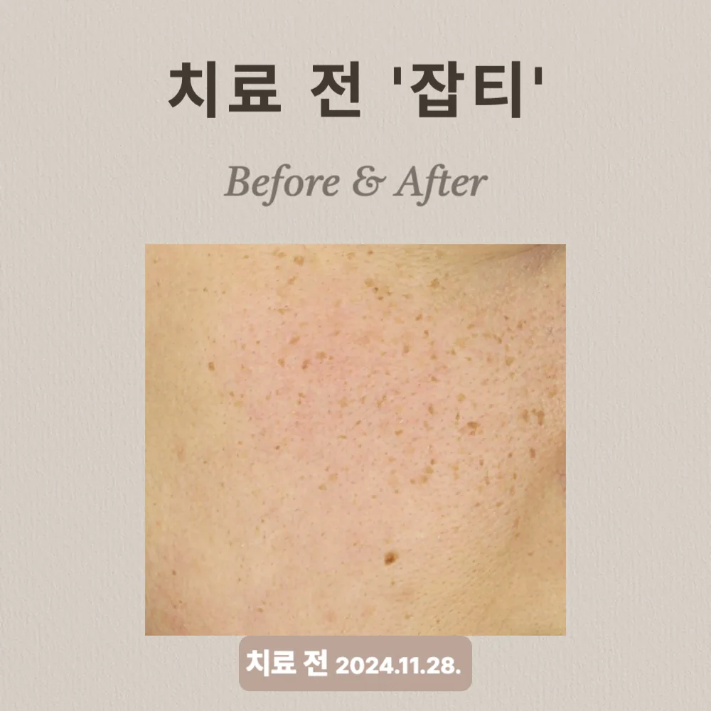 잡티 치료 상담 사례