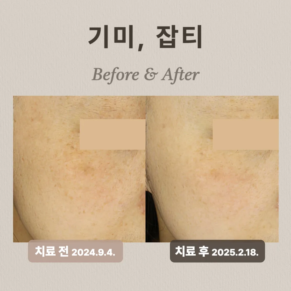 기미, 잡티 상담 사례