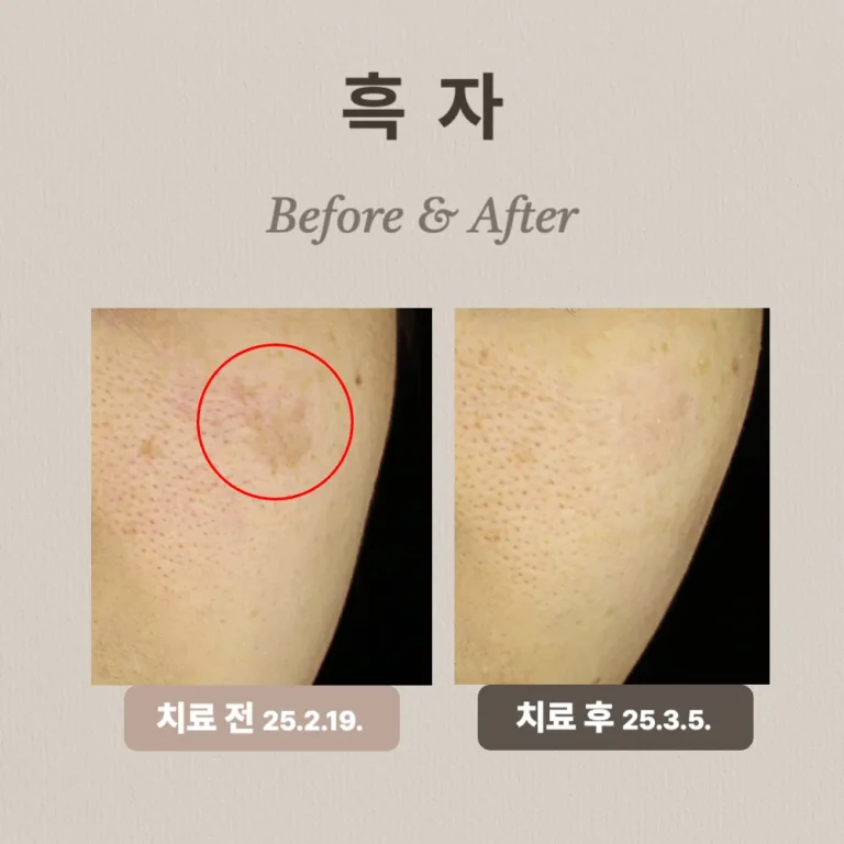 30대 흑자, 피부과 치료 후기