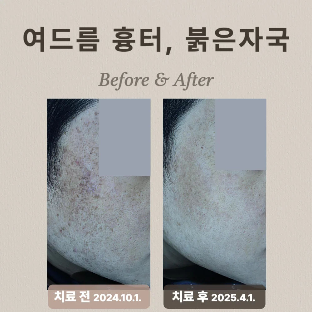 여드름 흉터와 홍반 상담 사례