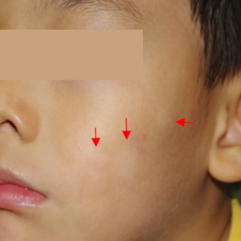 뺨에 나타난 10대 백반증 초기 병변 — 경계가 흐린 작은 흰 반점 부위 표시