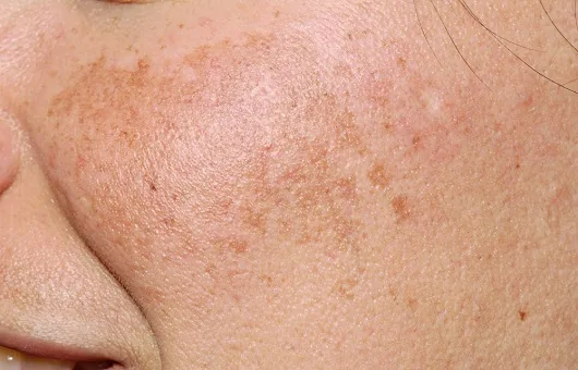 볼 주변에 기미가 번진 피부 — 기미치료, 피코토닝, 레이저토닝