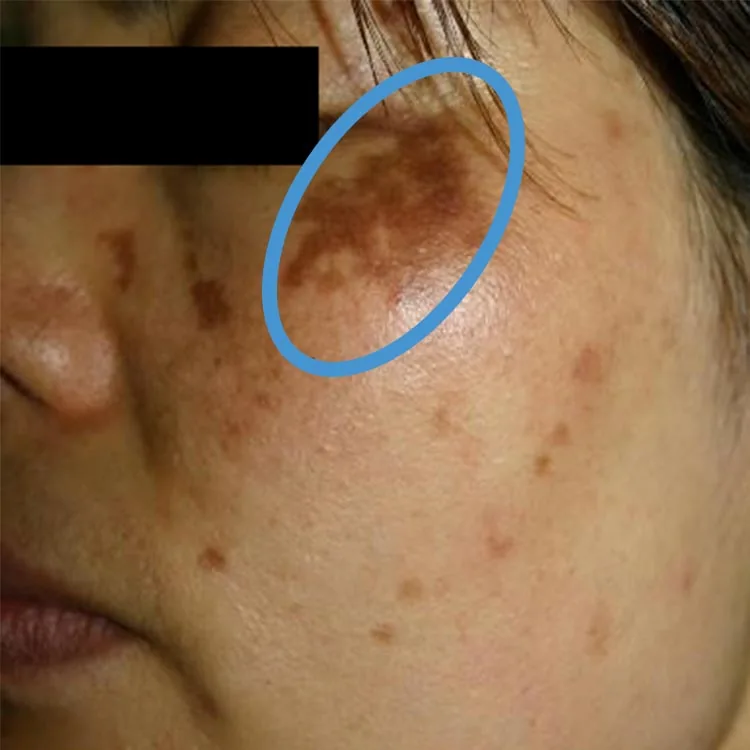 과색소침착 — 멜라닌이 과도한 자극을 받아 색소가 짙어진 피부