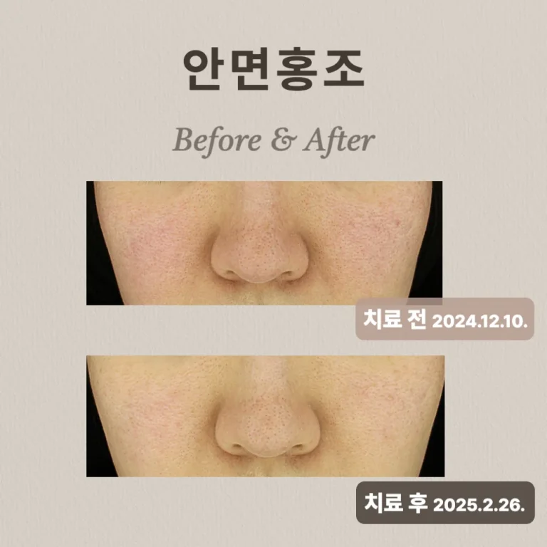 20대 여성, 주사피부염, 안면홍조 치료 후기