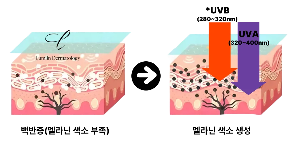 광선 치료 원리 도해 — 멜라닌 색소가 부족한 백반증 피부에 UVB·UVA를 조사하면 멜라닌 색소 생성이 유도되는 과정