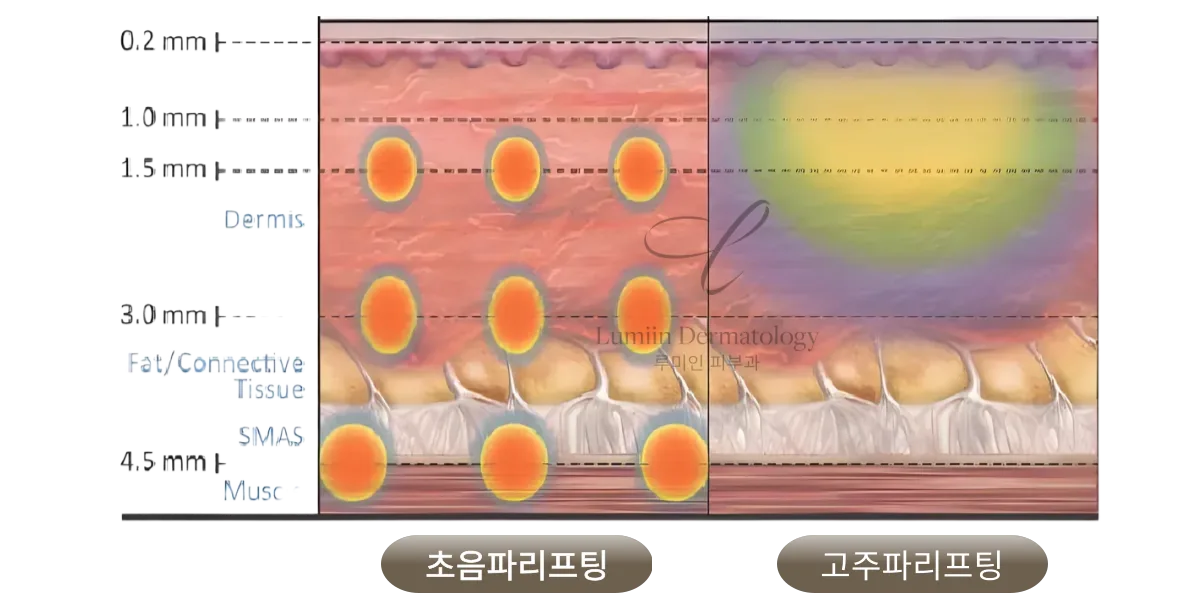 울쎄라 · 올리지오 · 써마지 비교 — 초음파리프팅과 고주파리프팅의 도달 층 차이