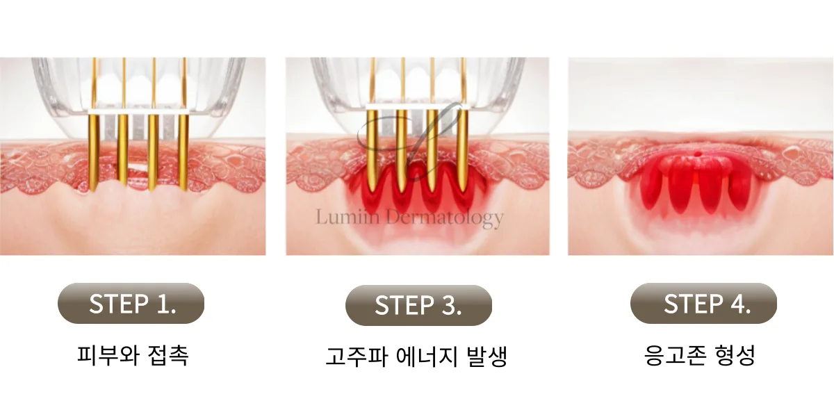 포텐자 여드름 치료 방법