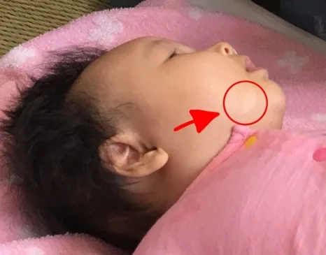 볼과 턱 주변에 경계가 뚜렷한 흰 반점이 나타난 아기 — 영유아 백반증 증상