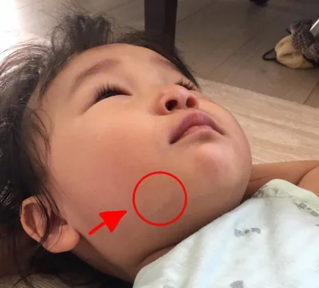 턱 아래 옅은 흰 반점이 관찰되는 아기 — 영유아 백반증 진단 상담 사례