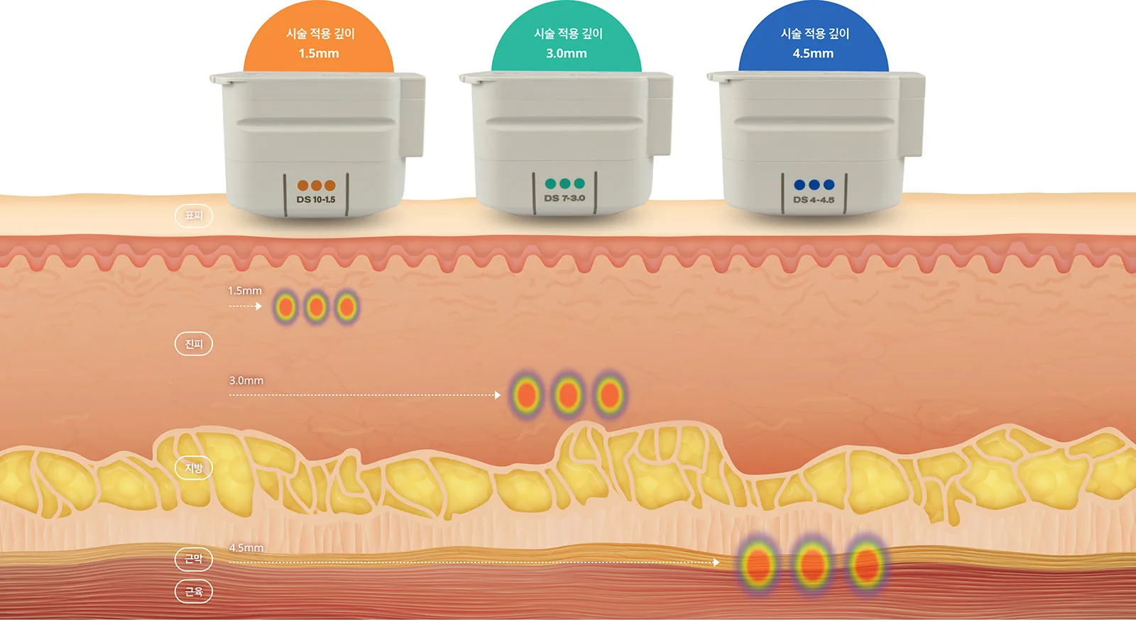 울쎄라의 원리 — 초음파 에너지가 피부 깊은 층에 열 응고점을 만드는 과정