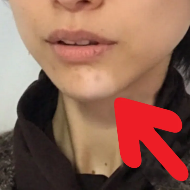 턱에 나타난 백반증 병변 — 치료가 늦어지면 확산될 수 있는 탈색반