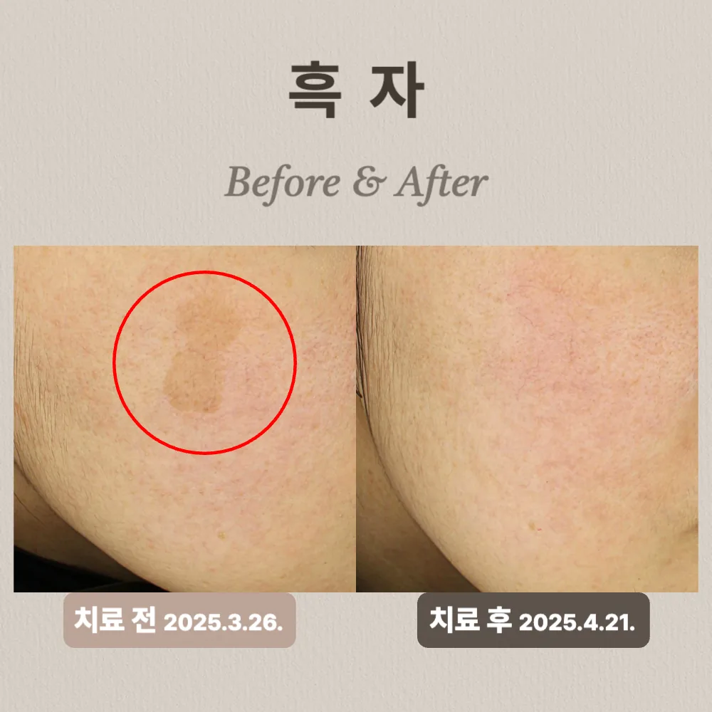20대 흑자 제거 상담 사례