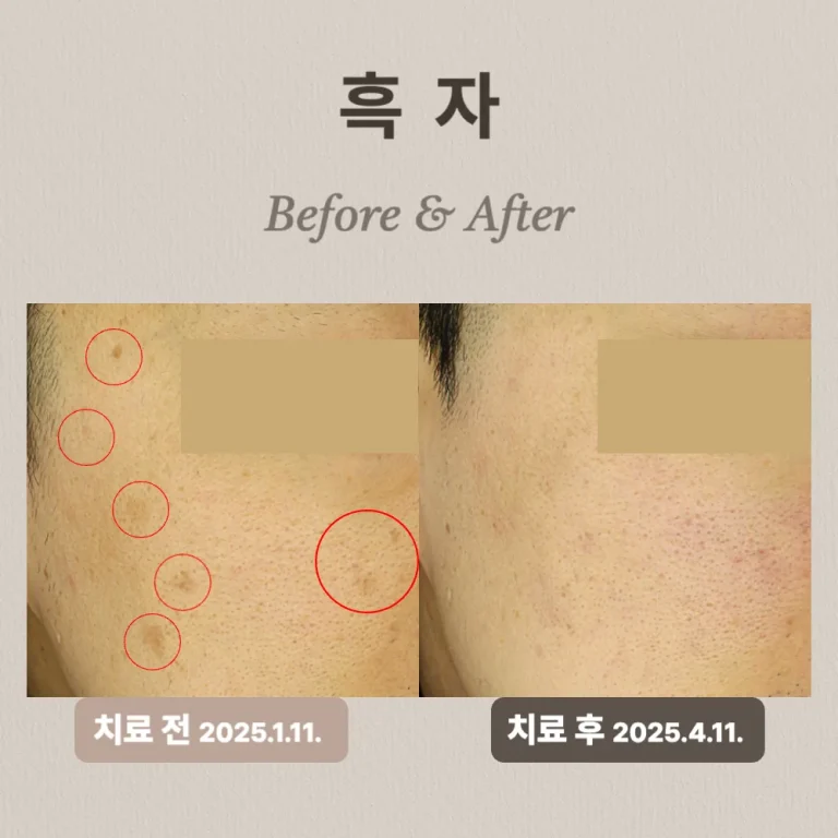 40대 흑자 치료 후기
