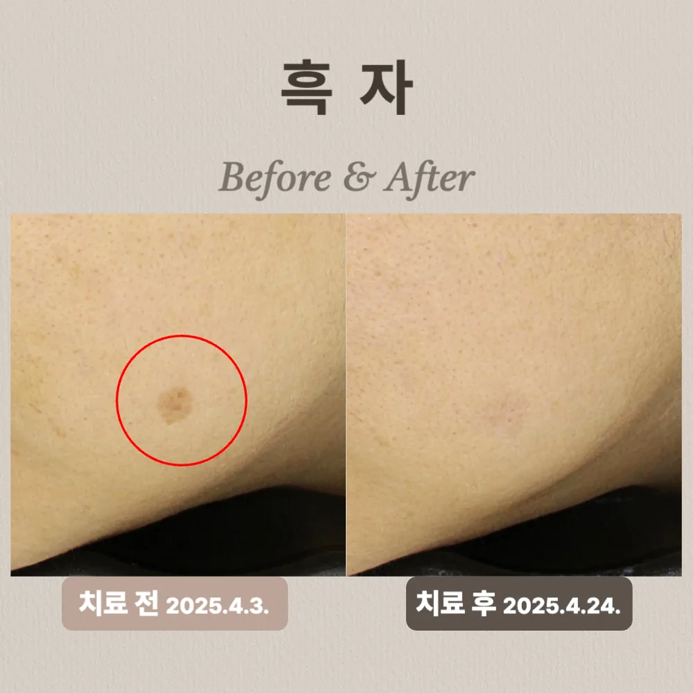 30대 흑자 제거 상담 사례