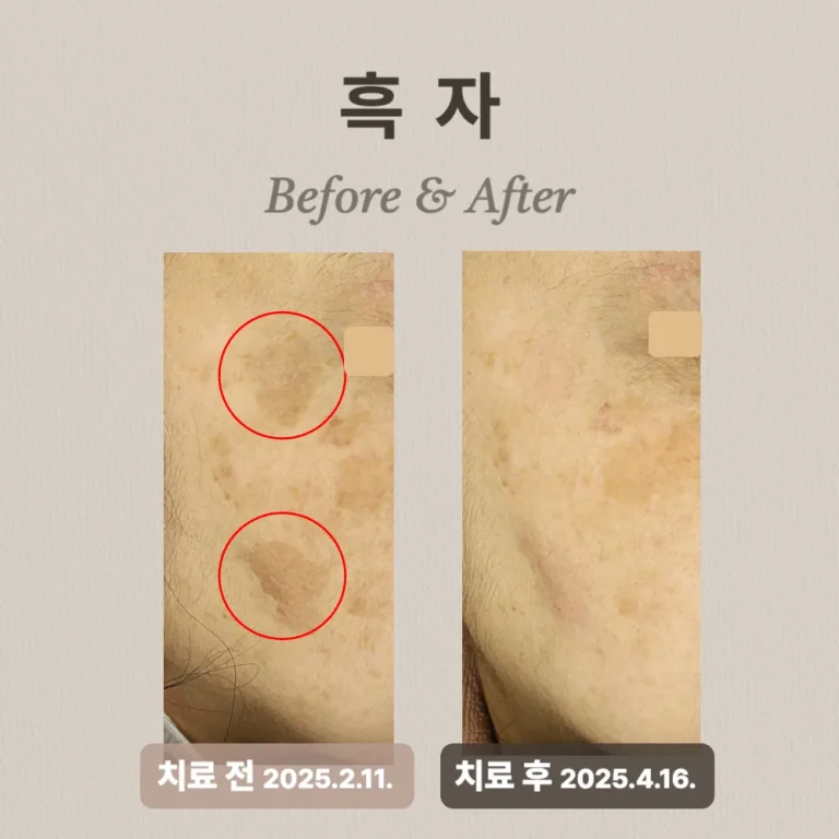 60대 여성, 흑자 제거 part1 치료 후기(기미 치료중)