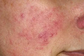 주사피부염(로사세아)이 진행된 피부 — 지속적인 붉음과 구진