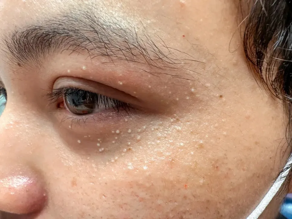 눈 주변에 하얗고 딱딱한 좁쌀 형태로 생긴 비립종 병변