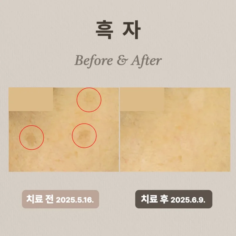 30대 흑자 치료 후기
