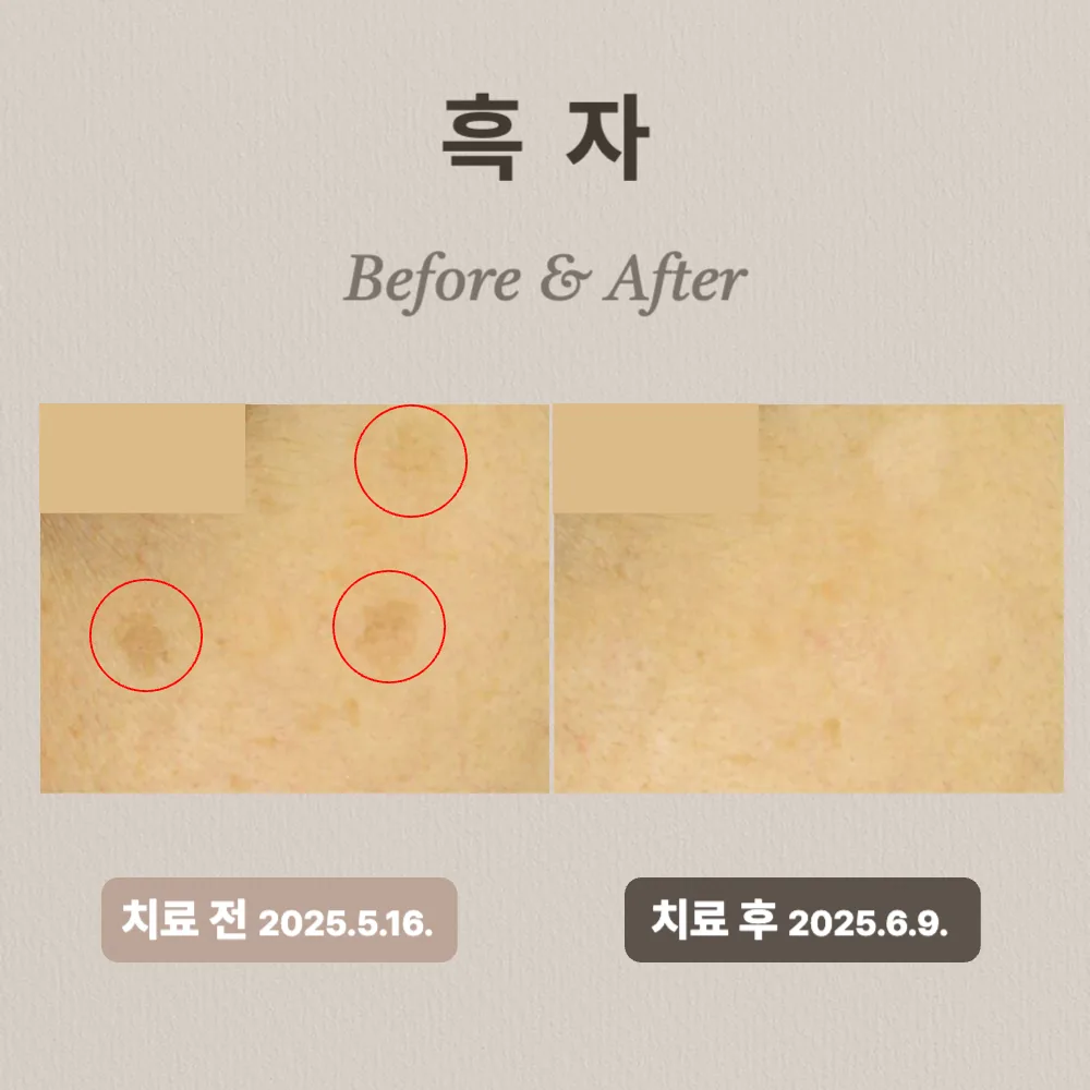 30대 흑자 치료 후기