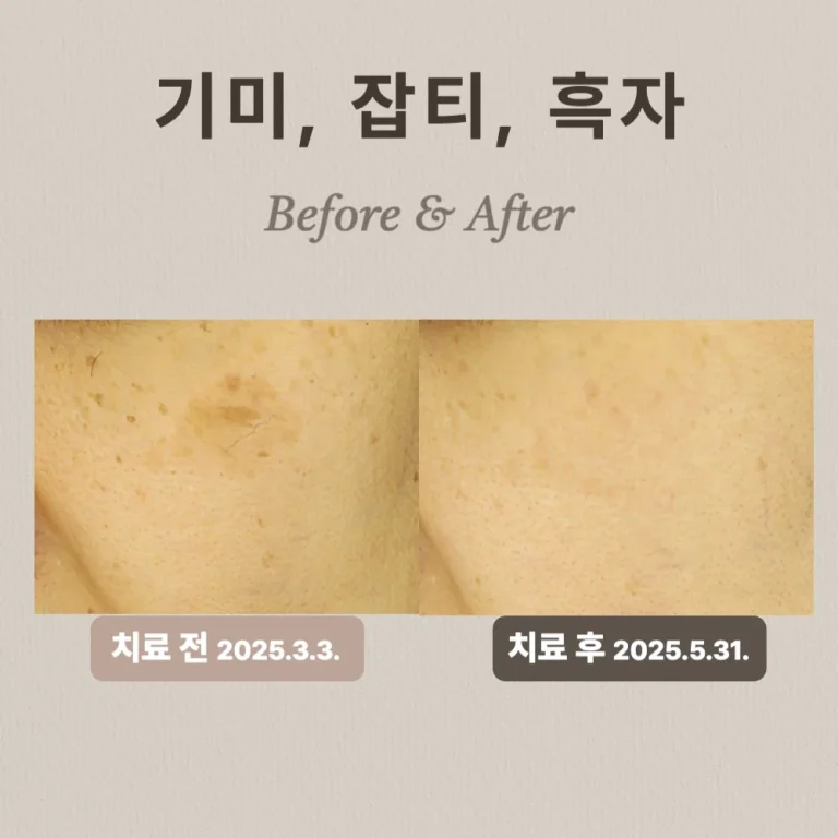 40대 여성, 기미, 잡티, 흑자 치료 후기