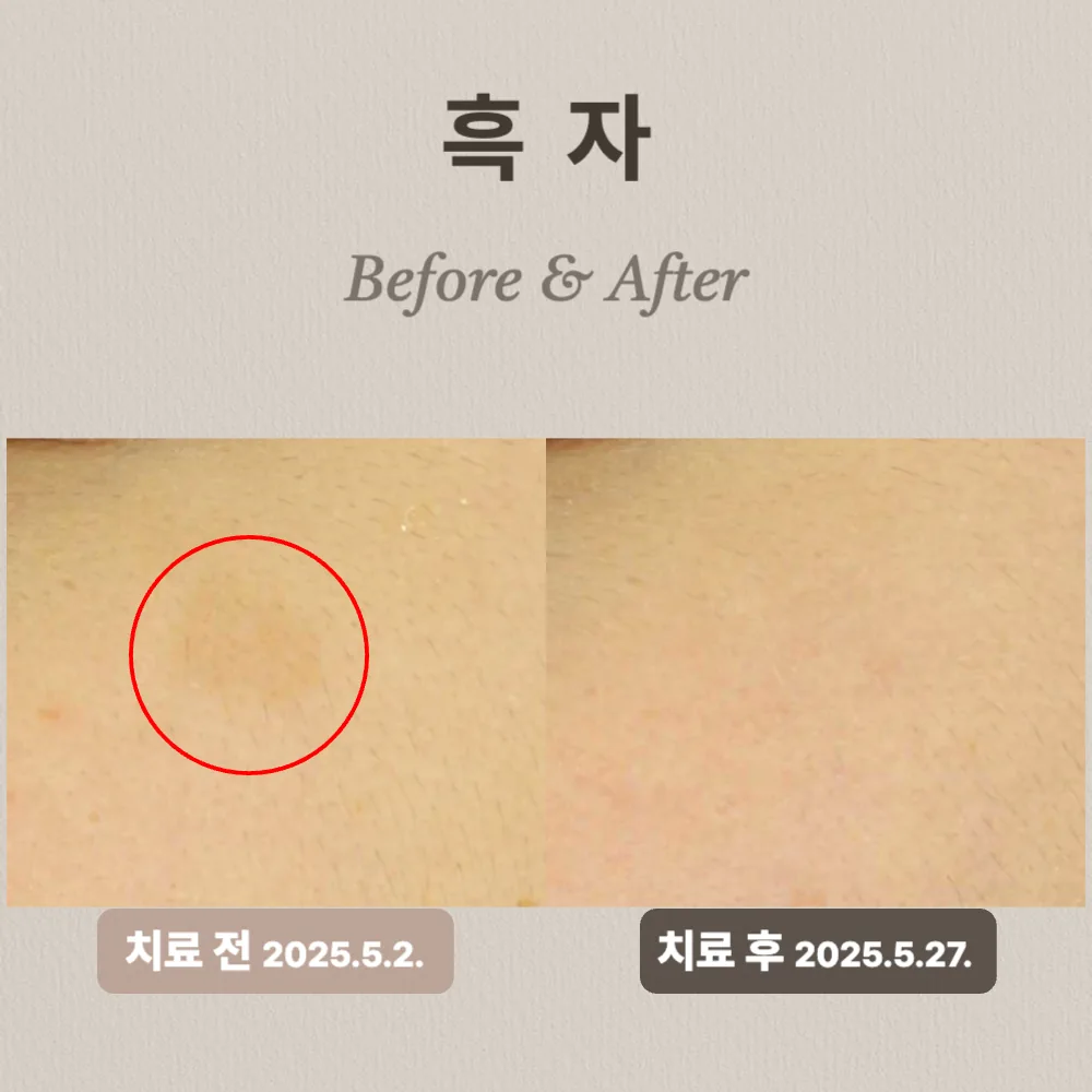 20대 여성 흑자 제거 후기