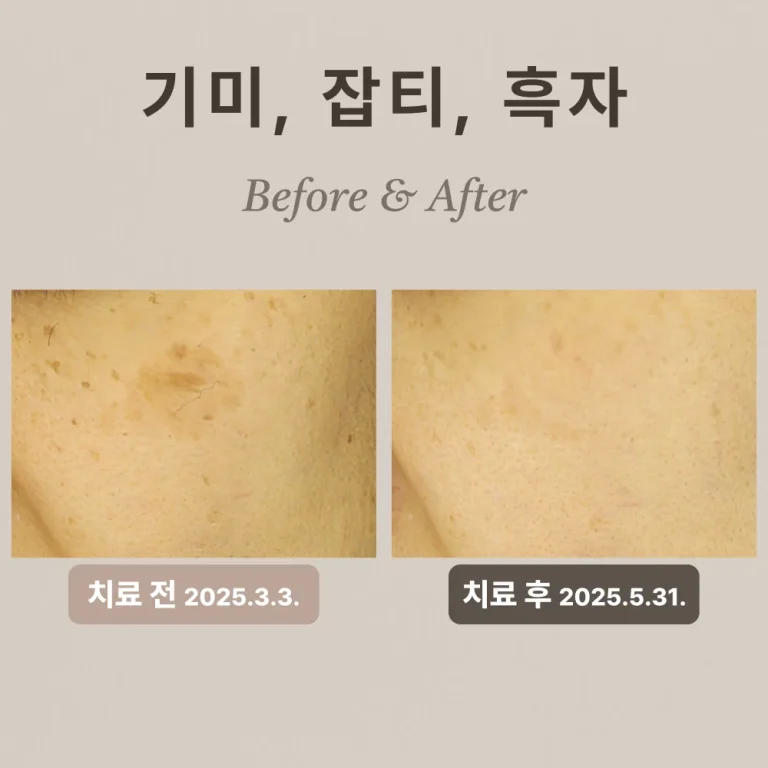 40대 여성 흑자 제거 후기 #기미, #잡티
