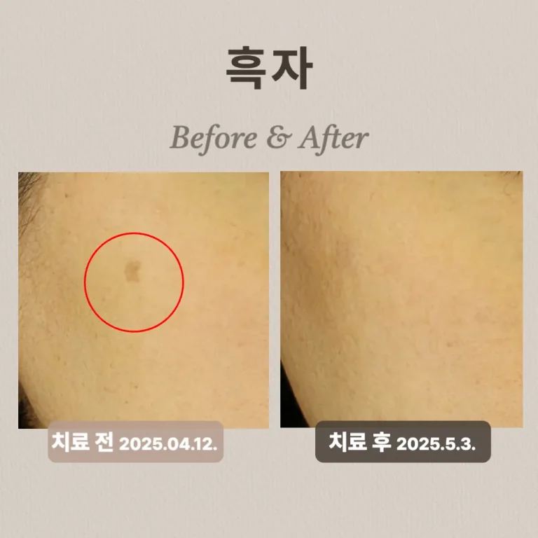 40대 여성 흑자 치료 후기