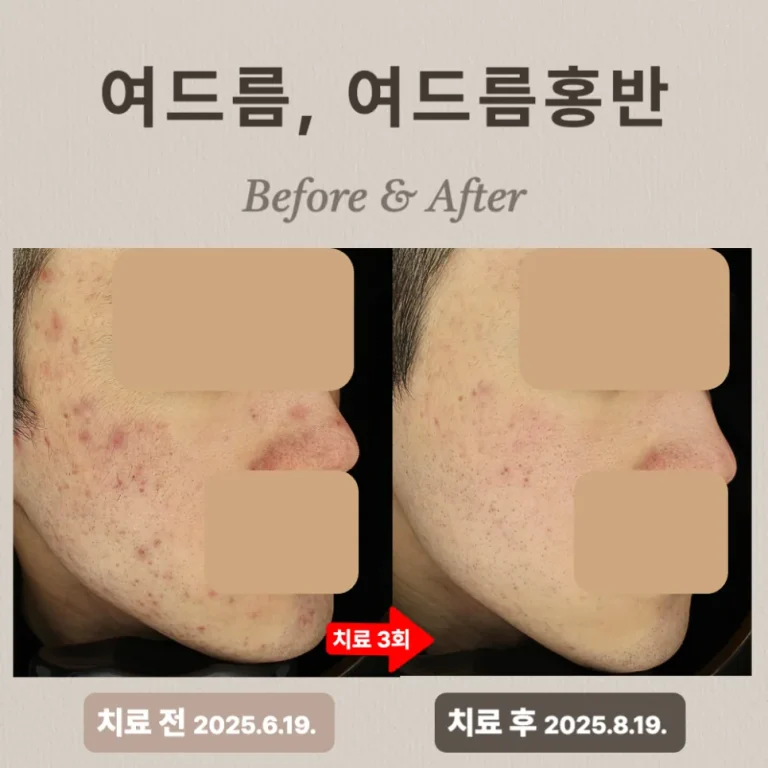 20대 여드름 압출·브이빔 치료 후기