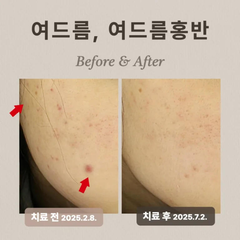 20대 여드름 붉은 자국, 브이빔 치료 후기와 효과는?