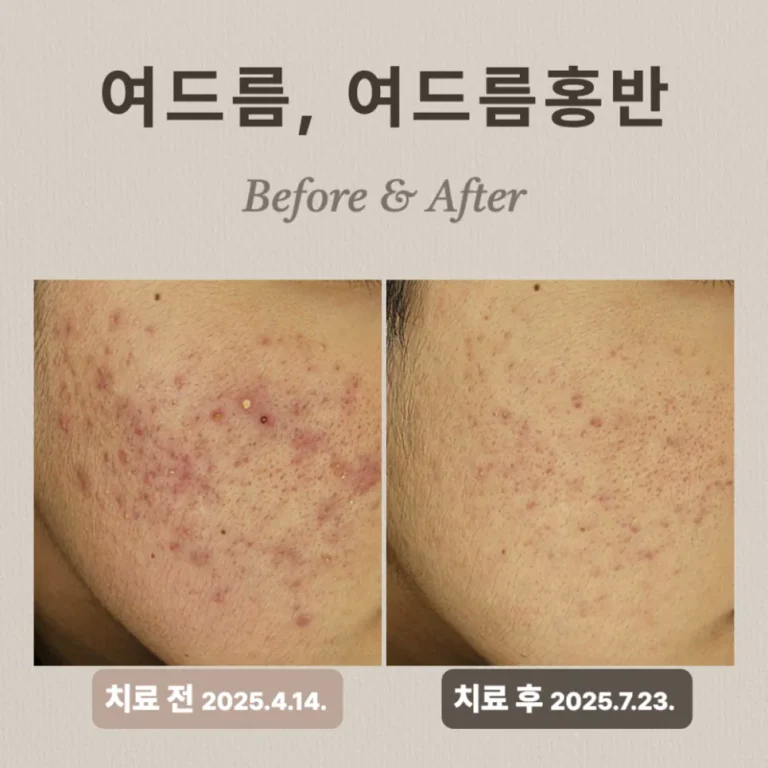 20대 홍반 치료 방법, 브이빔 시술 후기