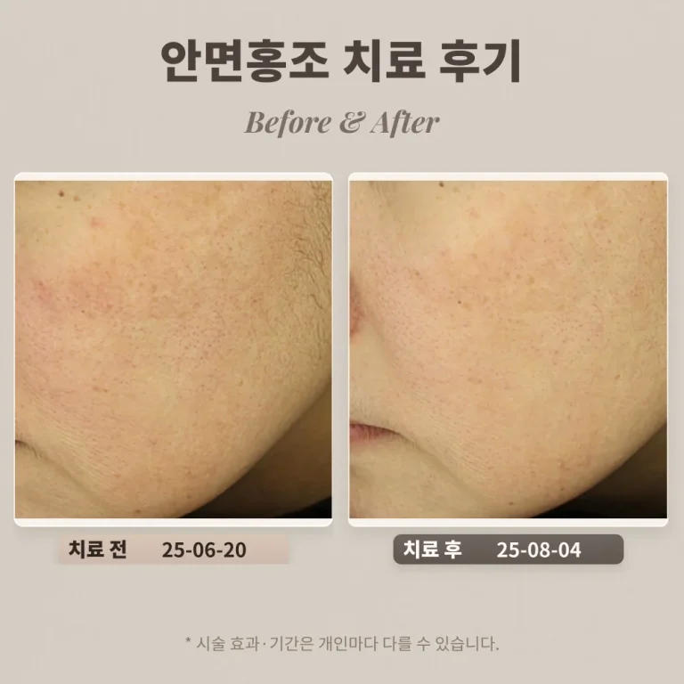 40대 여성 안면홍조, 붉은자국 치료 후기_대치동피부과전문의