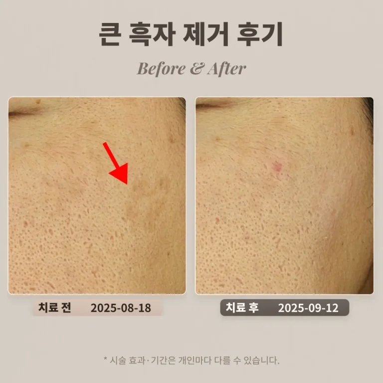 40대 남성 큰 흑자 제거 후기