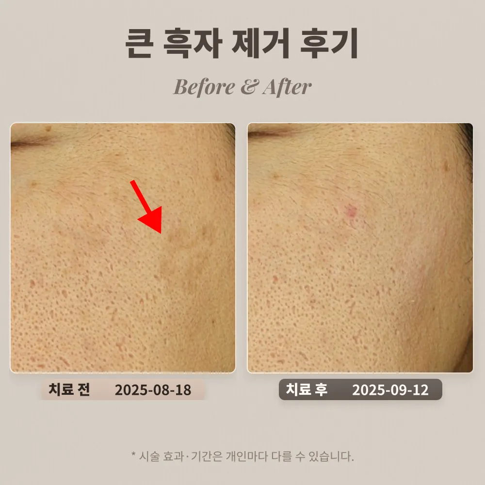 40대 남성 큰 흑자 제거 후기