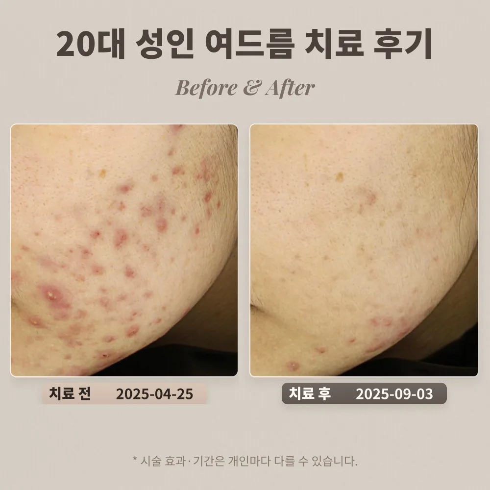 20대 여성 턱과 볼에 난 성인 여드름 치료 후기_대치동피부과