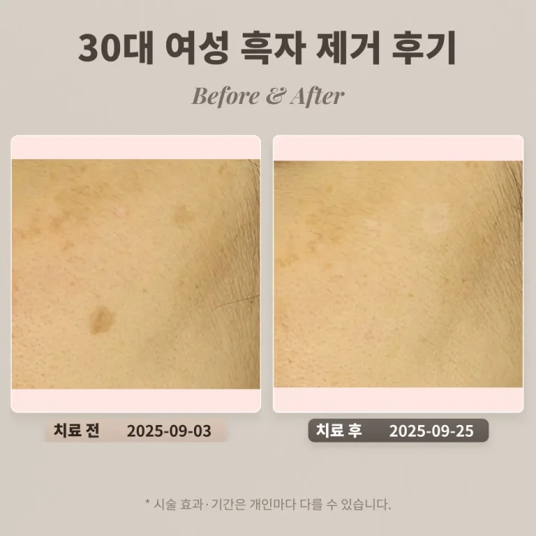 30대 여성 흑자 제거 후기 #얼굴에 난 갈색 반점