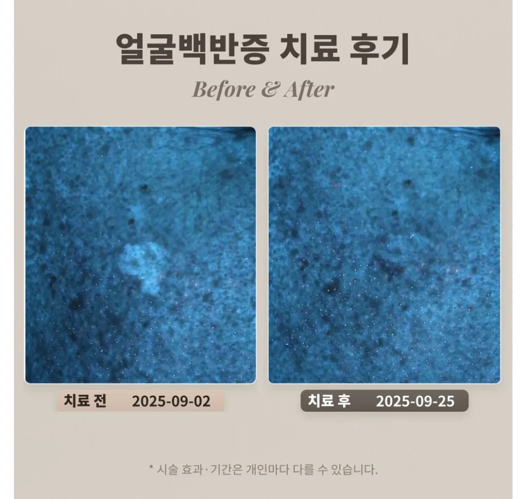 50대 남성 얼굴 백반증 치료 후기 #백반증전문피부과