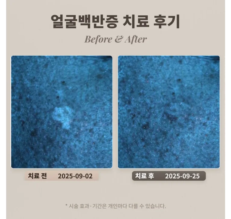 50대 남성 얼굴 백반증 치료 후기 #백반증전문피부과